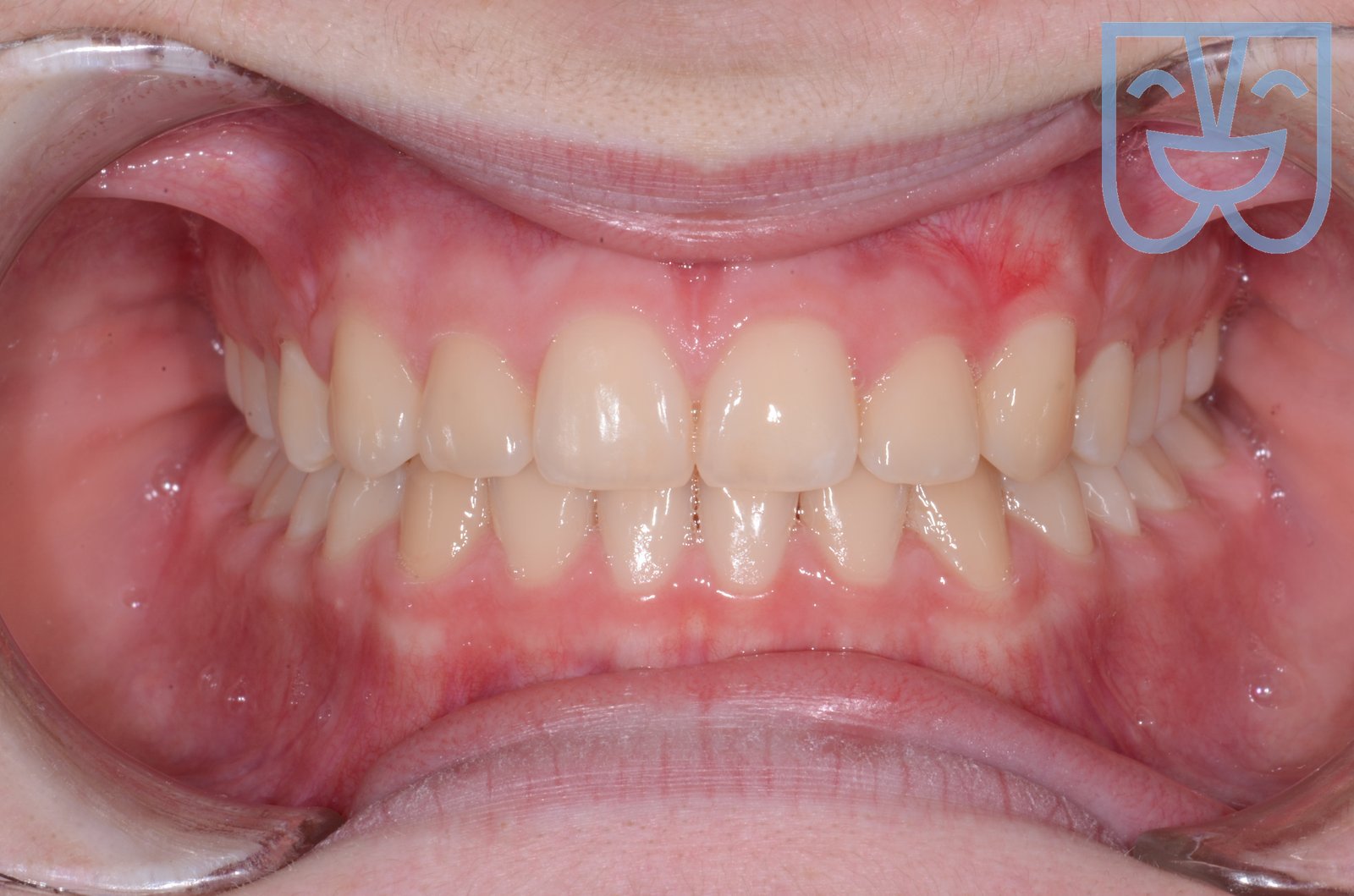 Caso 01 — vista frontale dopo il trattamento