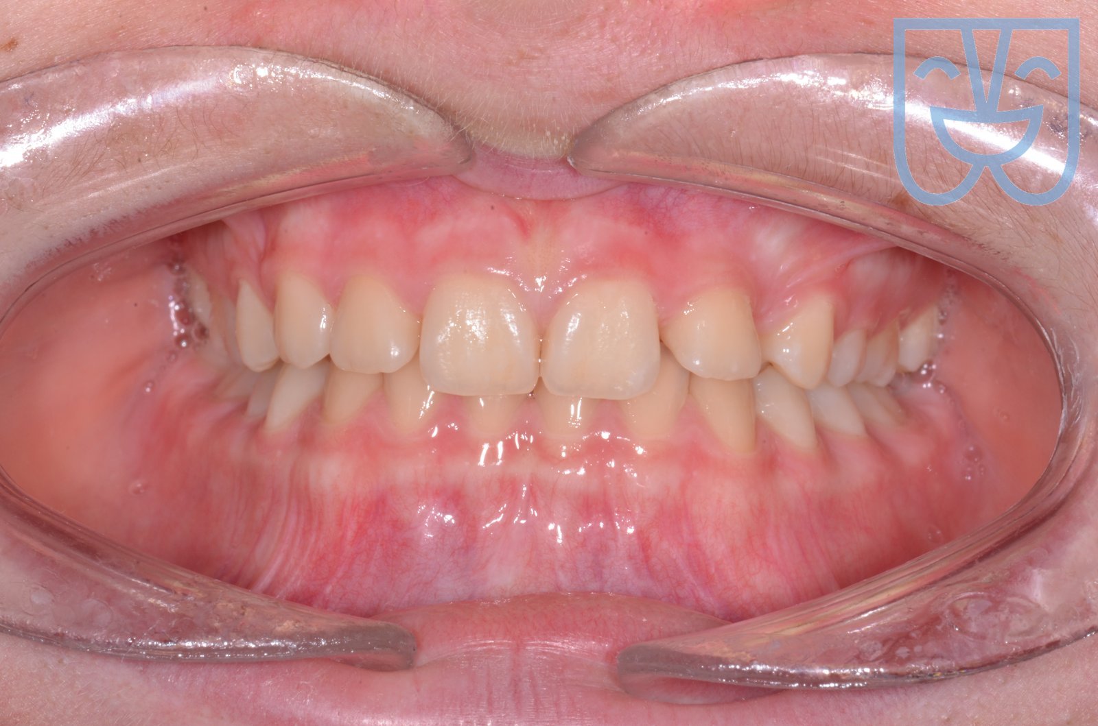 Caso 01 — vista frontale prima del trattamento