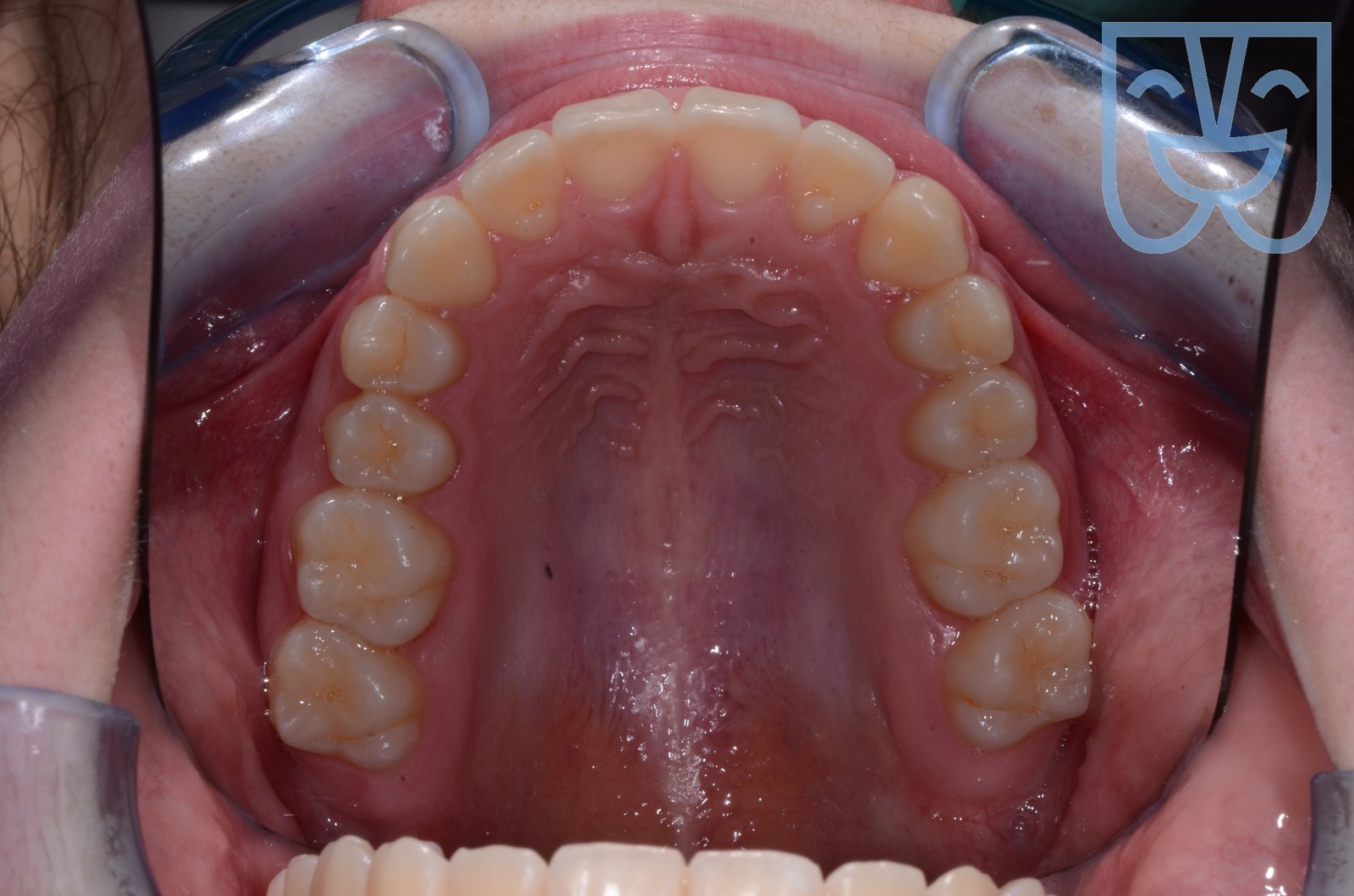 Caso 01 — vista occlusale dopo il trattamento