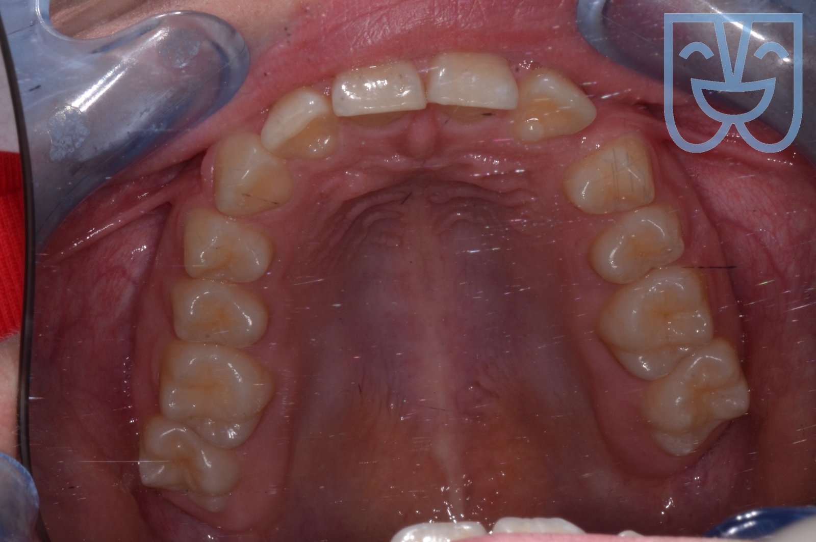 Caso 01 — vista occlusale prima del trattamento