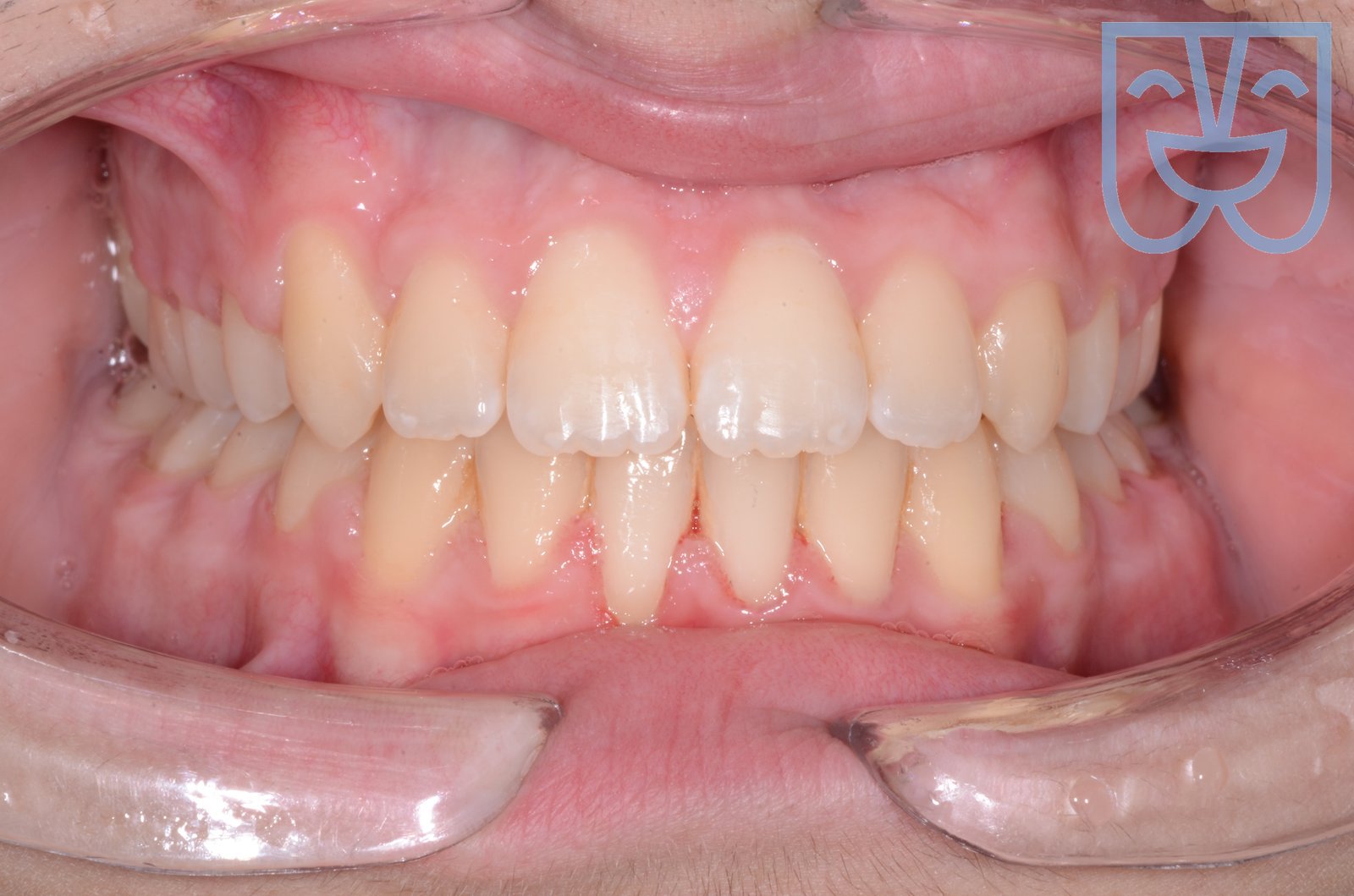 Caso 02 — vista frontale dopo il trattamento