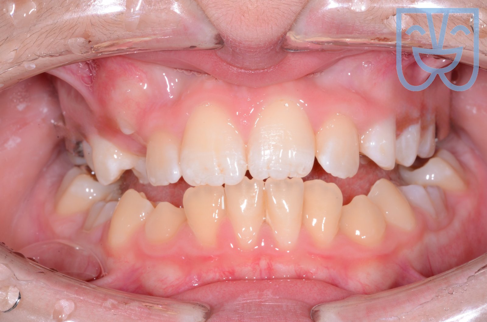 Caso 02 — vista frontale prima del trattamento