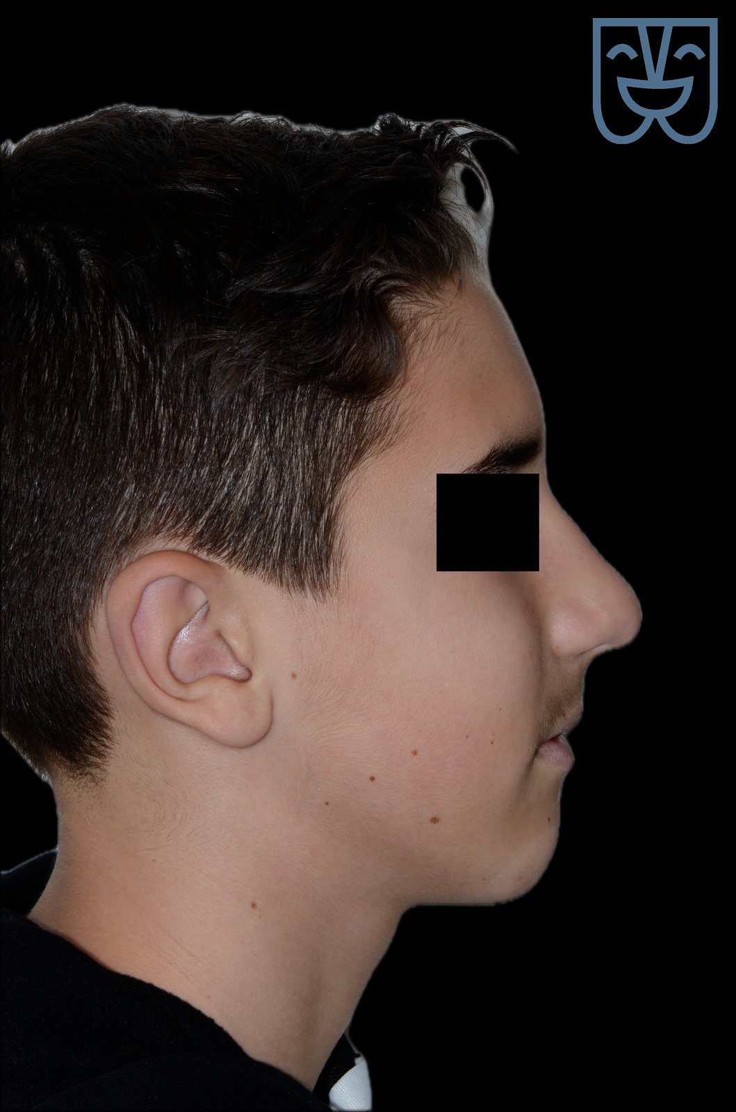 Caso 02 — profilo dopo il trattamento