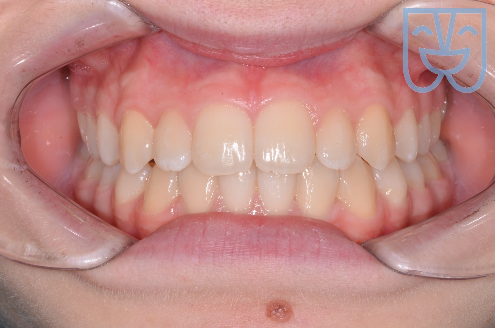 Caso 03 — vista frontale dopo il trattamento