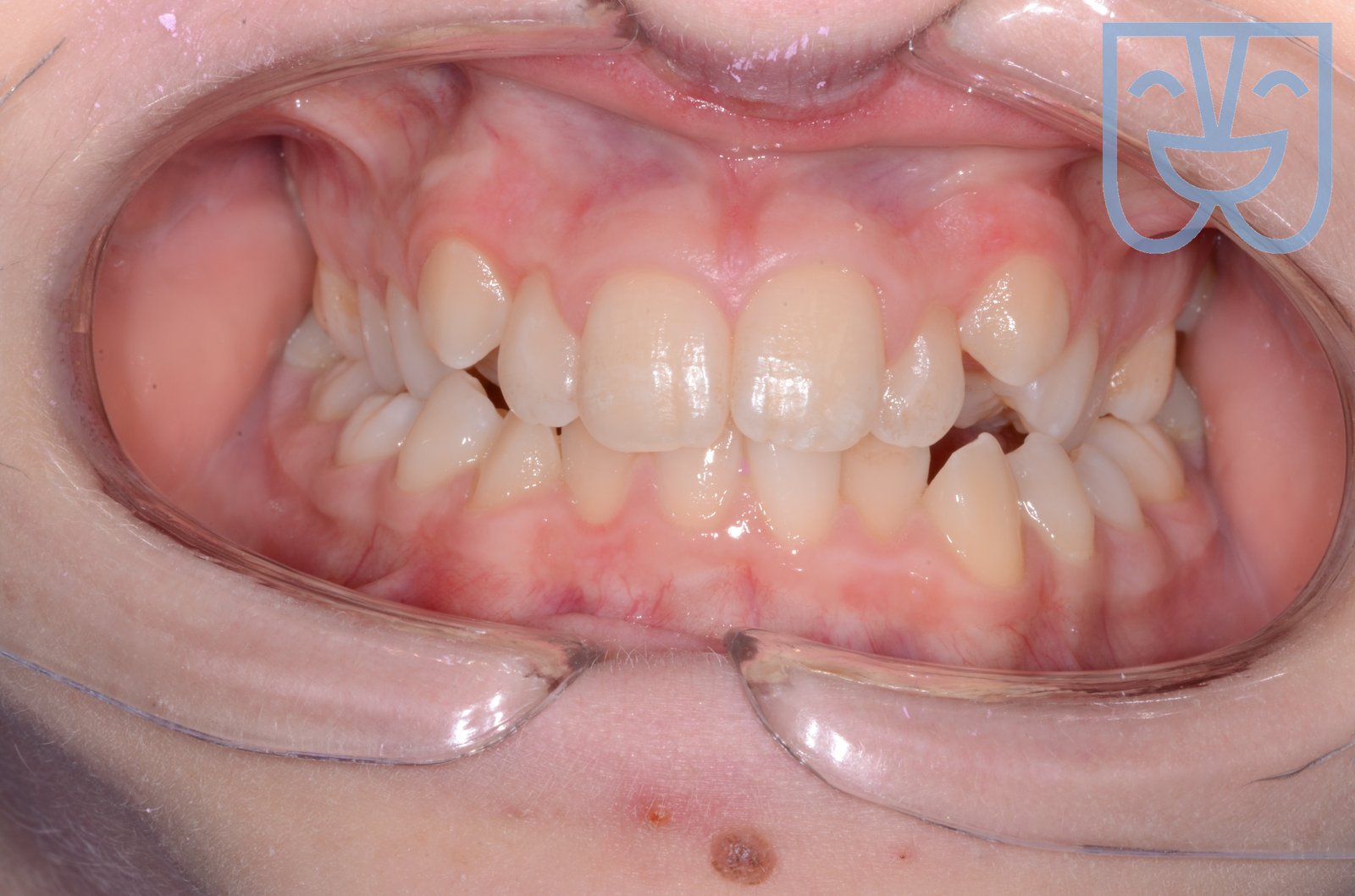 Caso 03 — vista frontale prima del trattamento