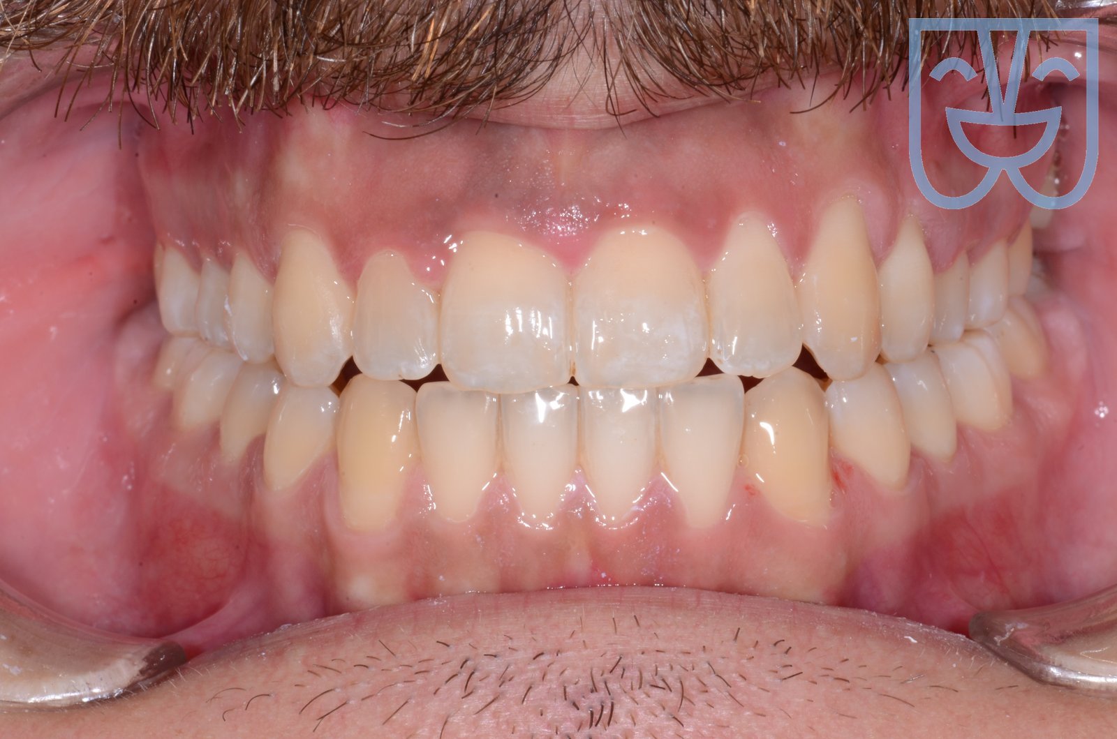 Open bite — vista frontale dopo il trattamento