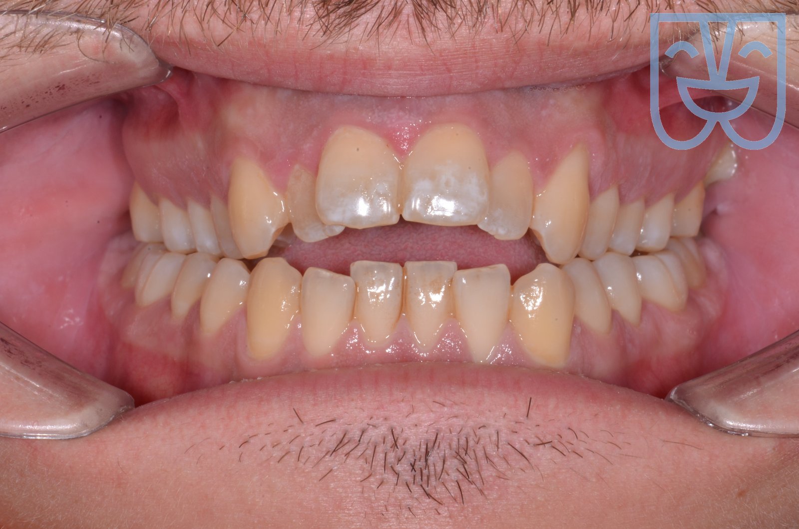 Open bite — vista frontale prima del trattamento