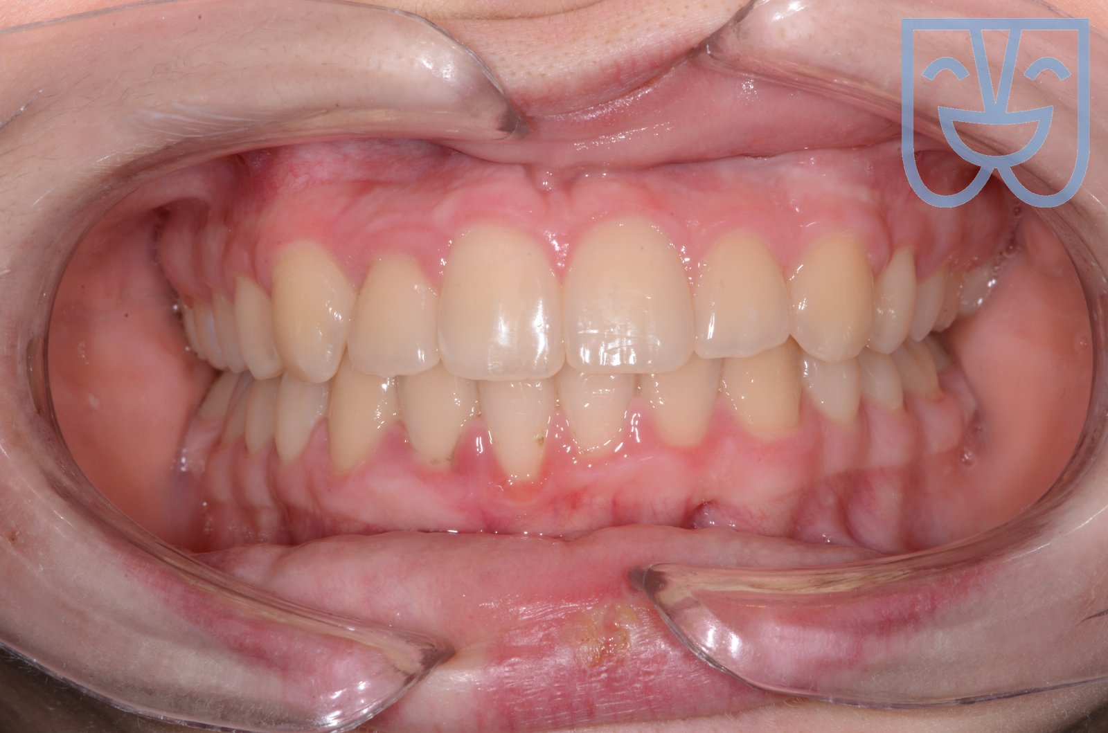 Caso 05 — vista frontale dopo il trattamento