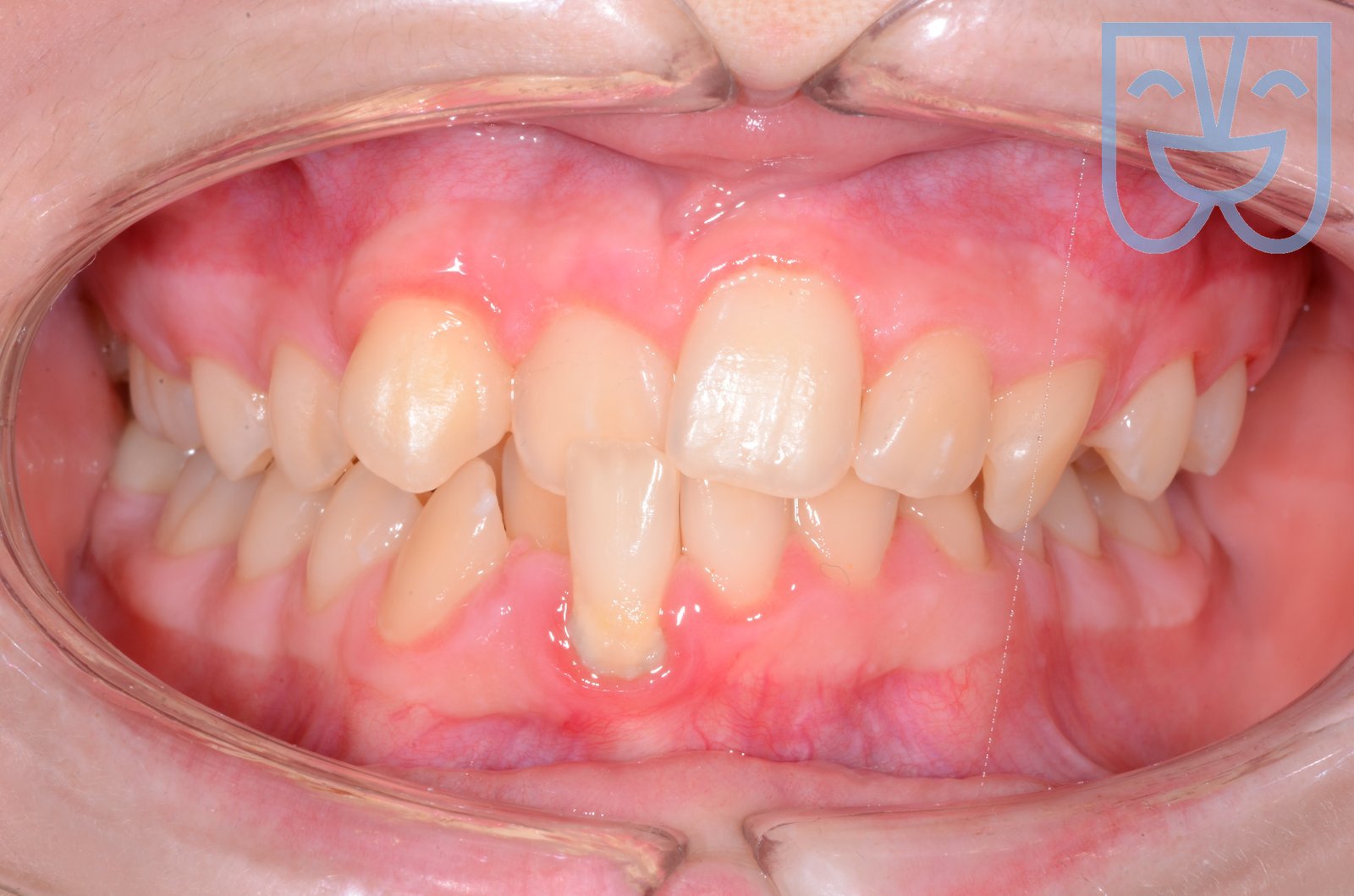 Caso 05 — vista frontale prima del trattamento
