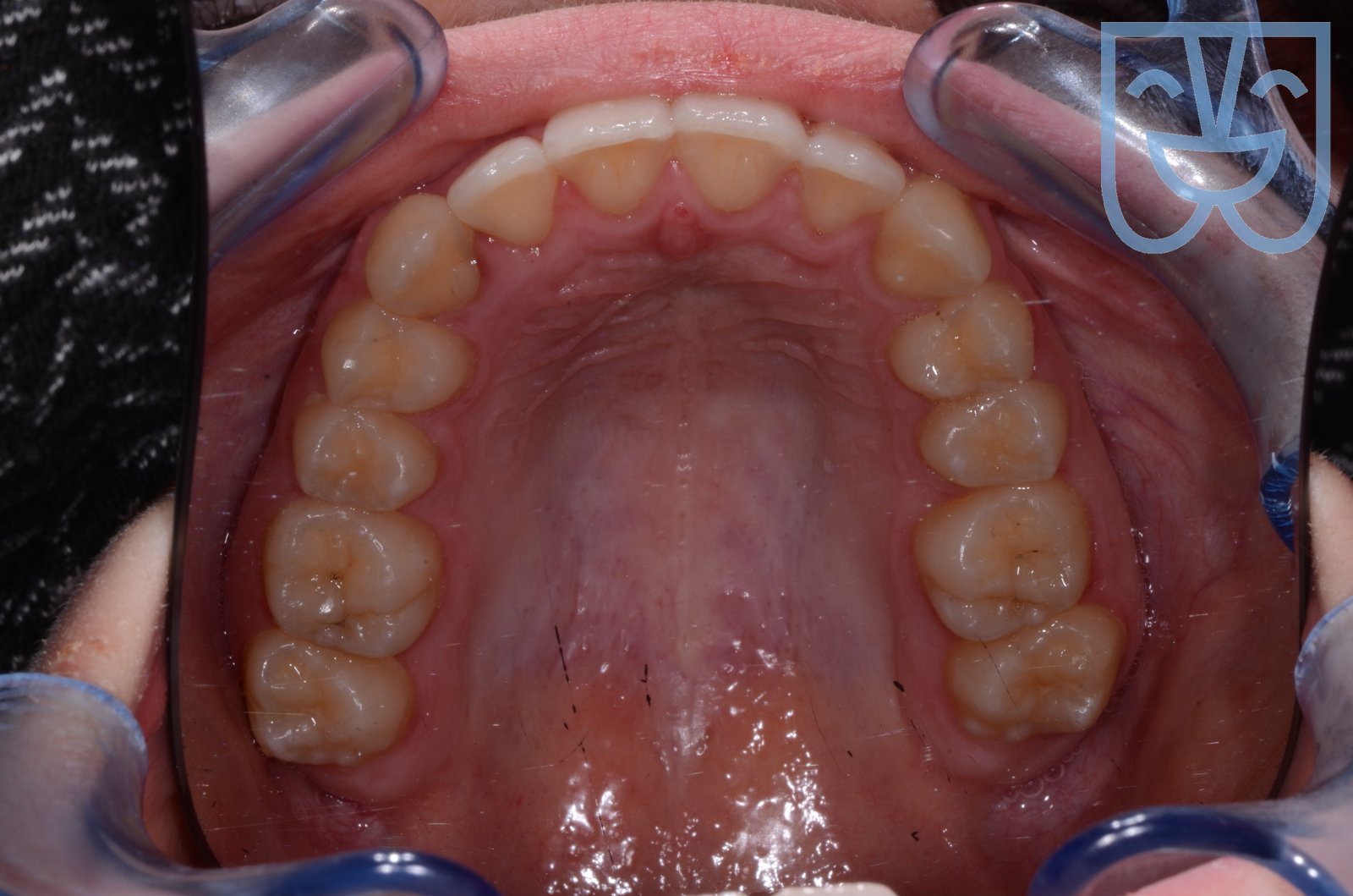 Caso 05 — vista occlusale dopo il trattamento