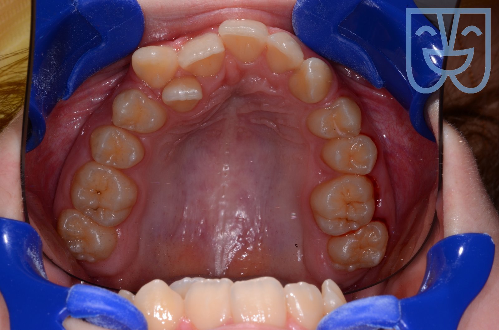 Caso 05 — vista occlusale prima del trattamento