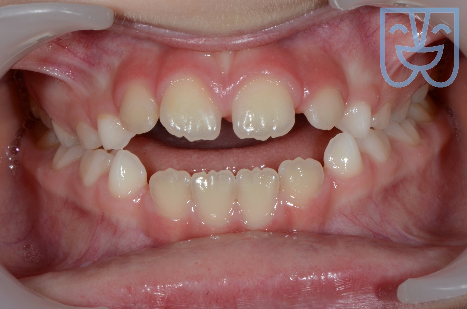 Morso aperto scheletrico — prima del trattamento