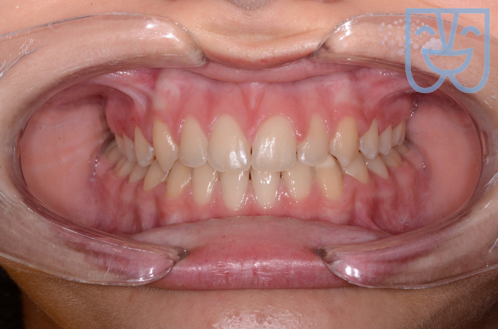 Morso aperto scheletrico — dopo il trattamento